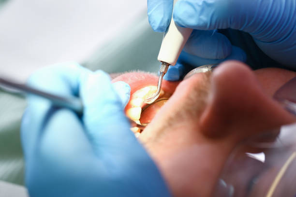 Best Emergency Tooth Extraction in Downs, IL